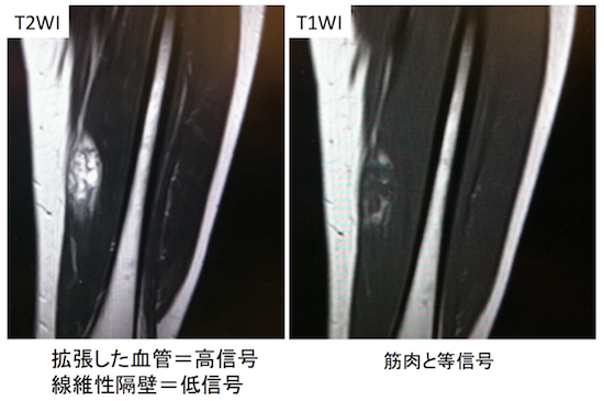 軟部組織の血管腫/静脈奇形のCT,MRI画像診断のポイント